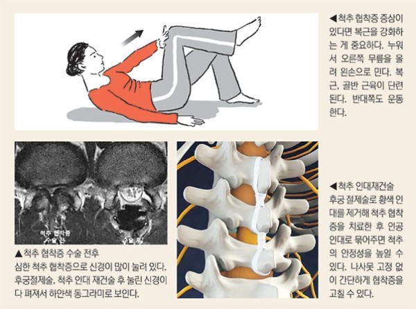 척주협착증 복근강화운동